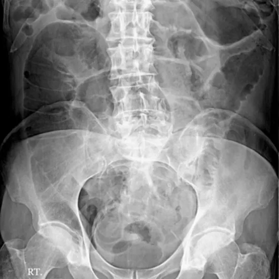 x-ray abdomen ap view test
